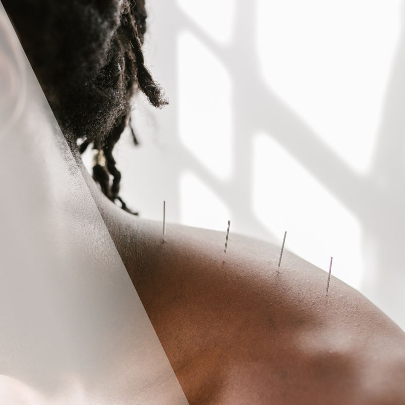 Five Benefits of Consistent Acupuncture Treatments » Jupiter